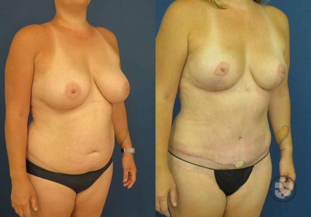 Before photo - Angle 2