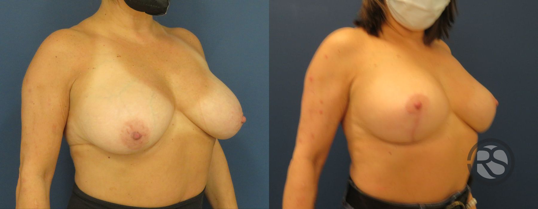 Before photo - Angle 4