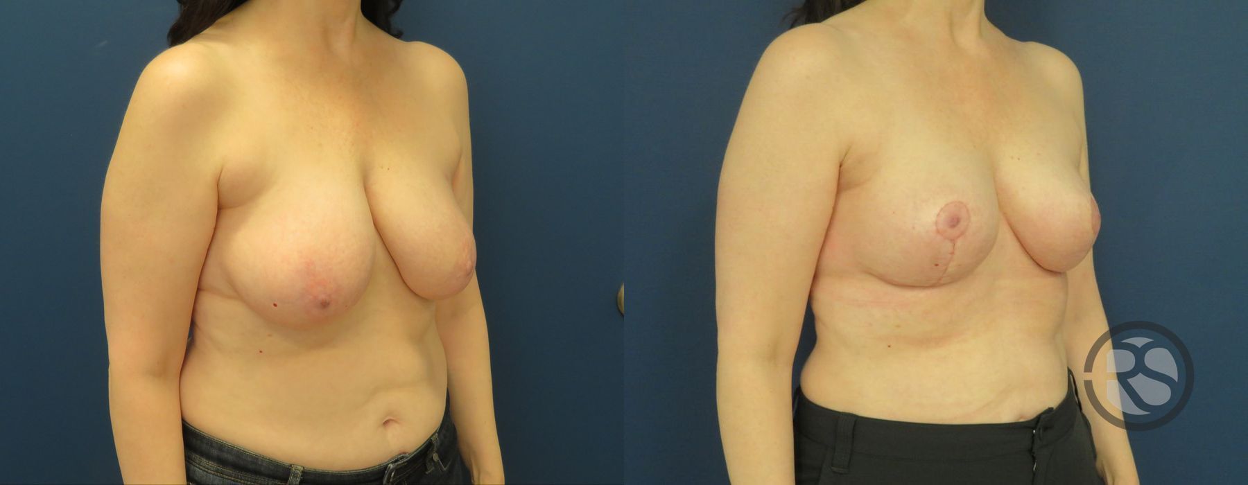 Before photo - Angle 4