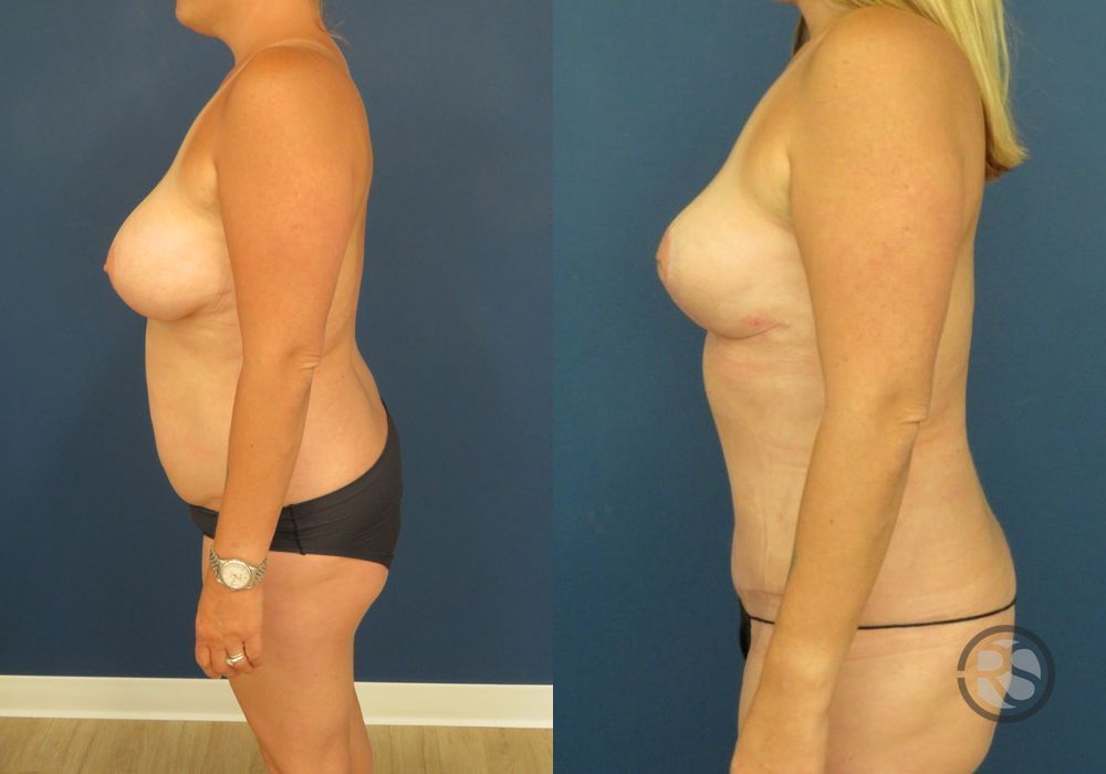 Before photo - Angle 5