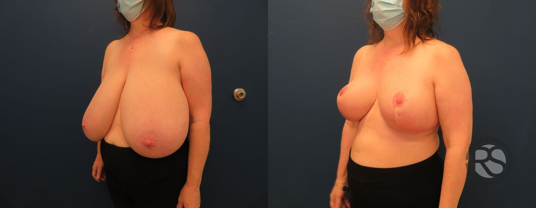 Before photo - Angle 4