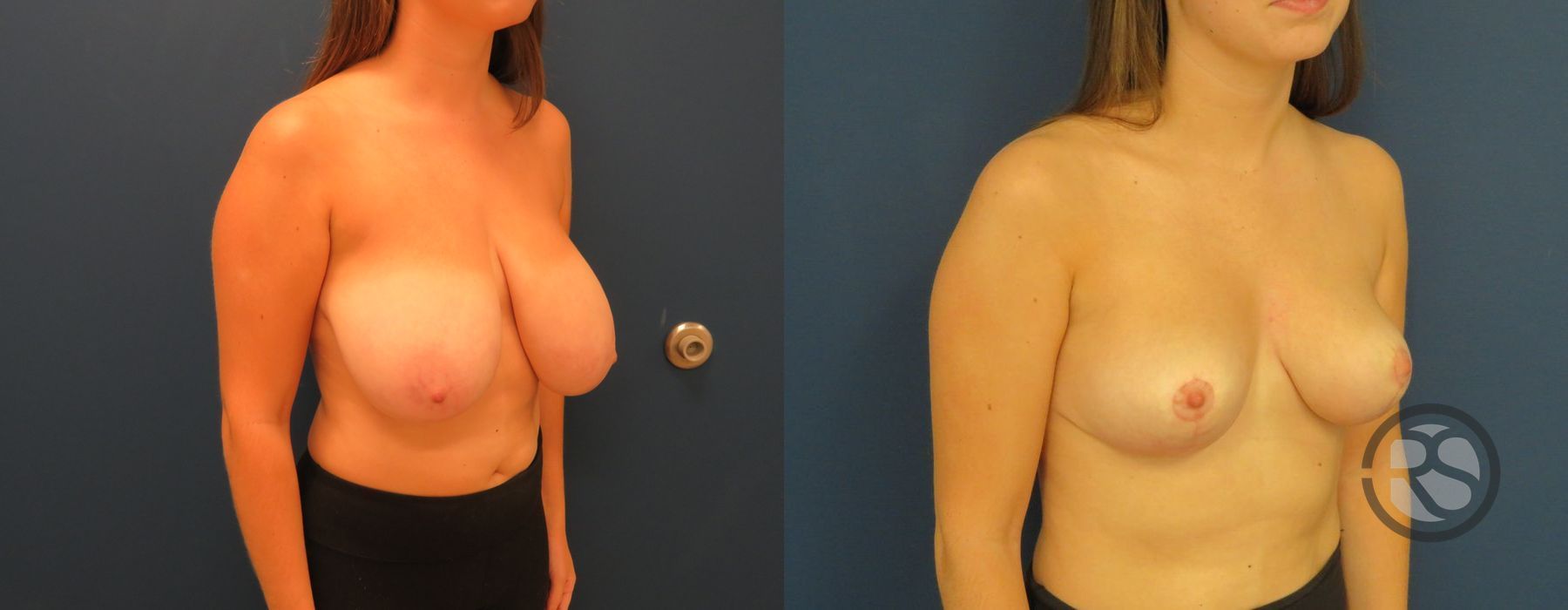 Before photo - Angle 2