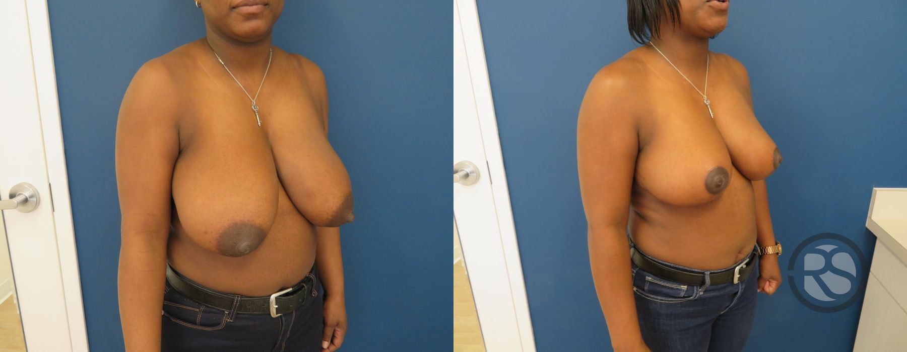 Before photo - Angle 2