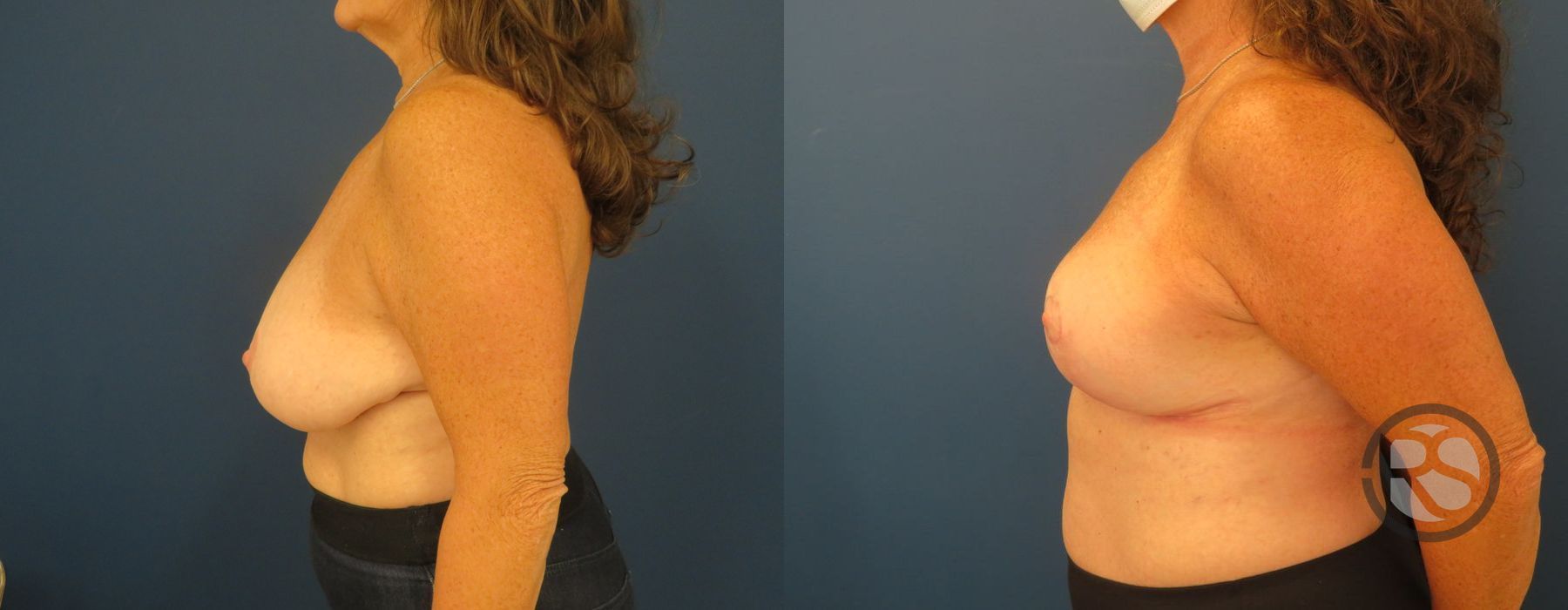 Before photo - Angle 3