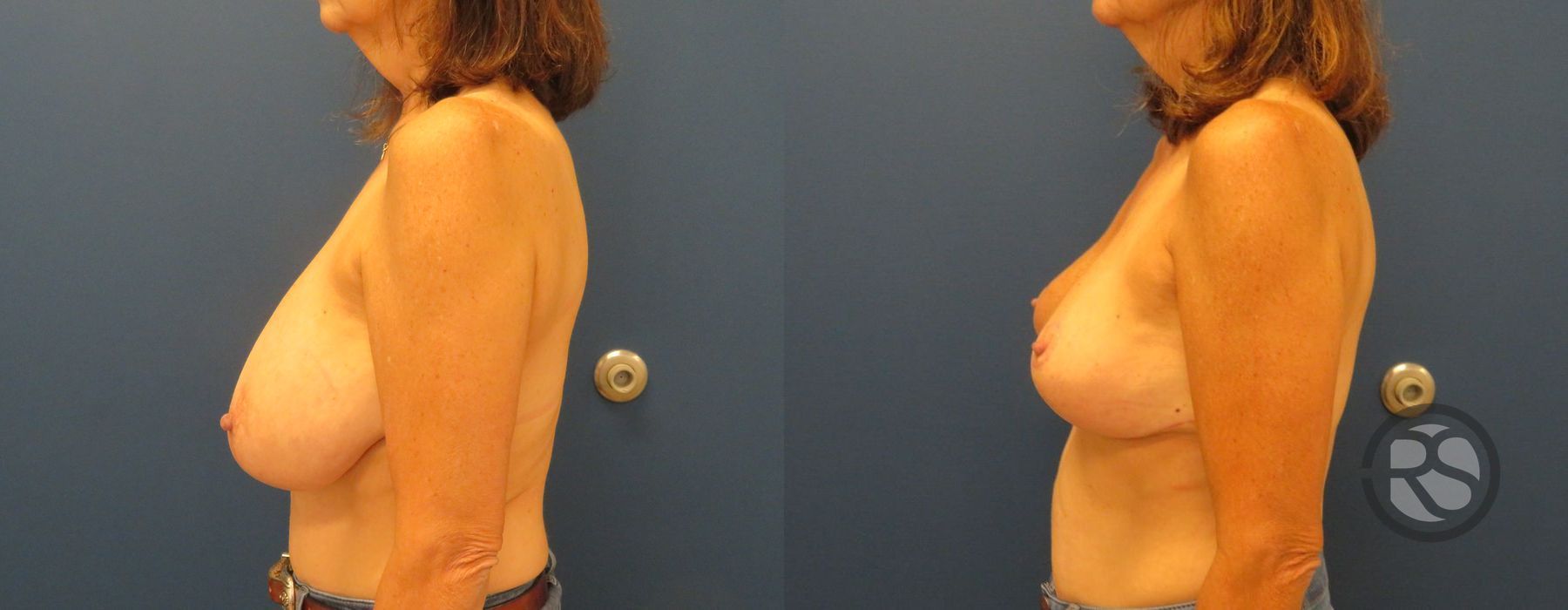 Before photo - Angle 5