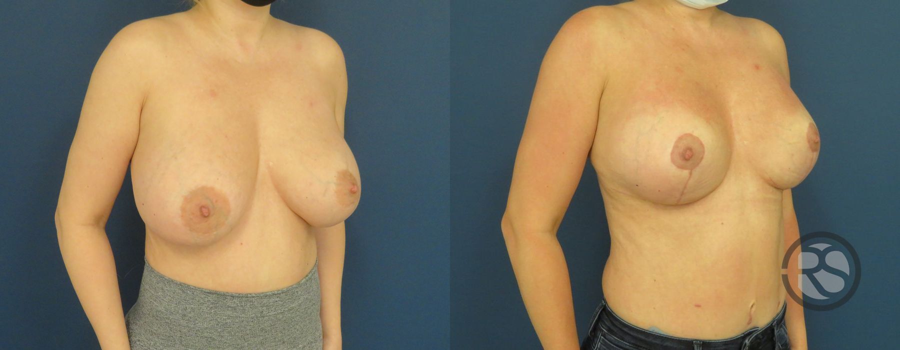 Before photo - Angle 2