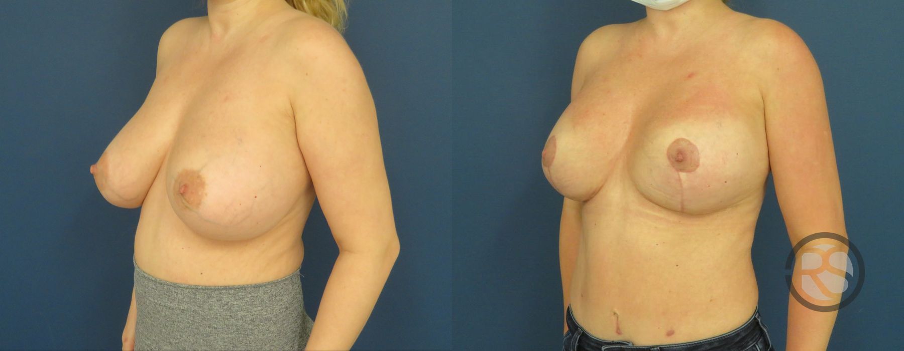 Before photo - Angle 4