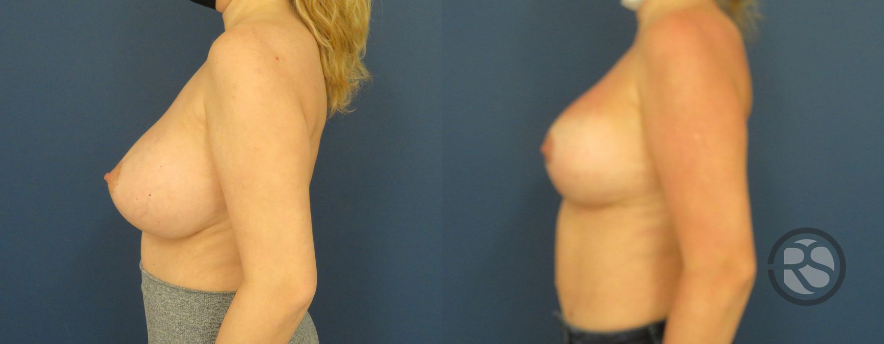 Before photo - Angle 5