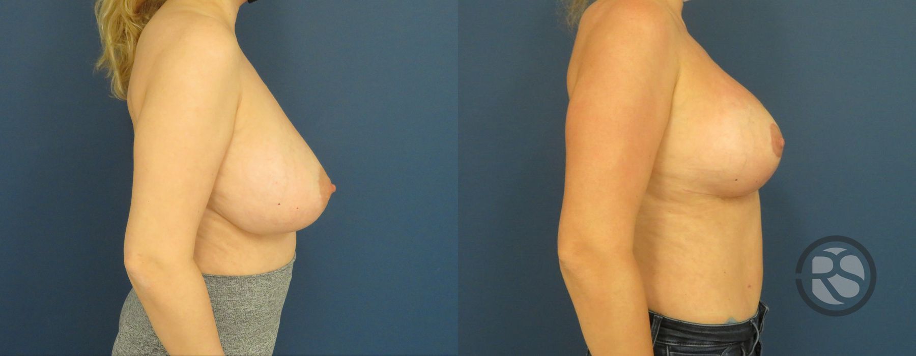 Before photo - Angle 3