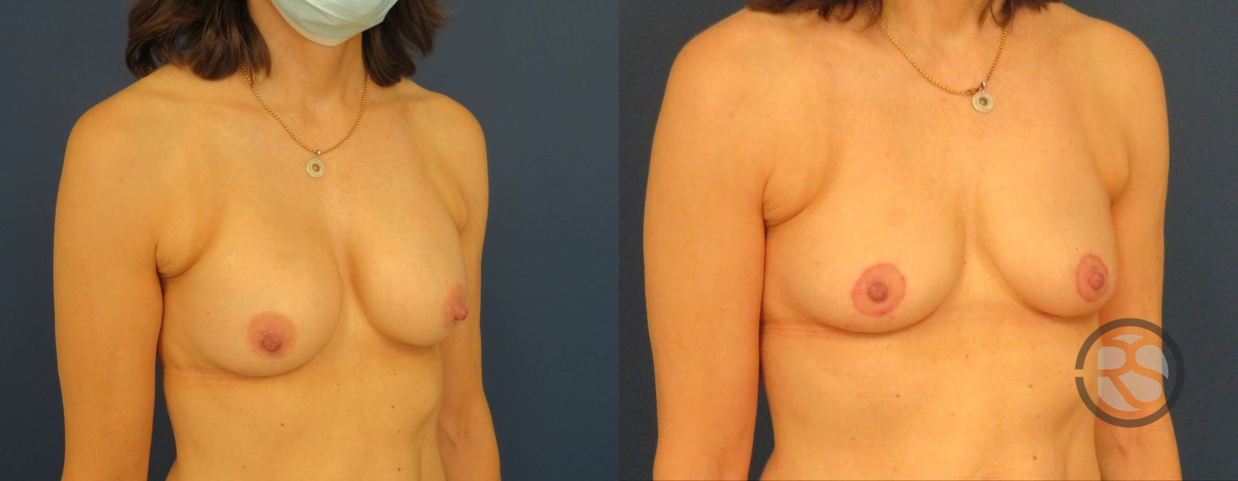 Before photo - Angle 4