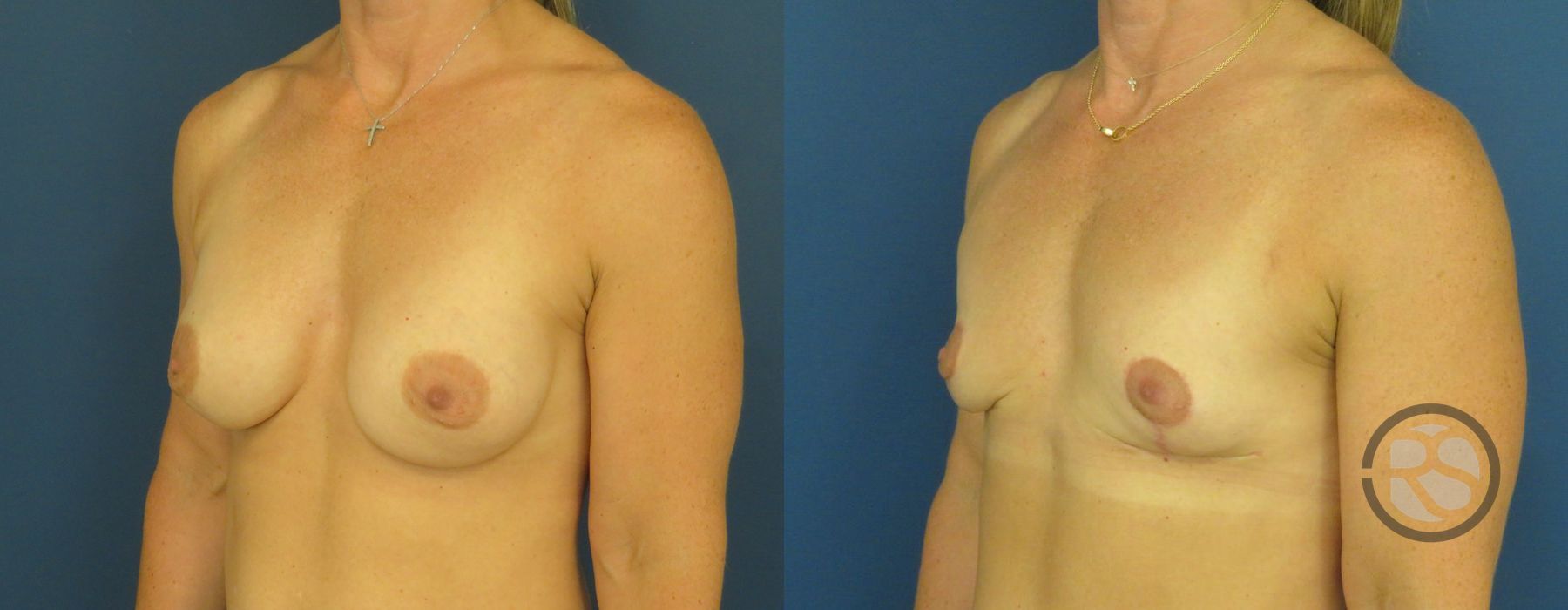 Before photo - Angle 4