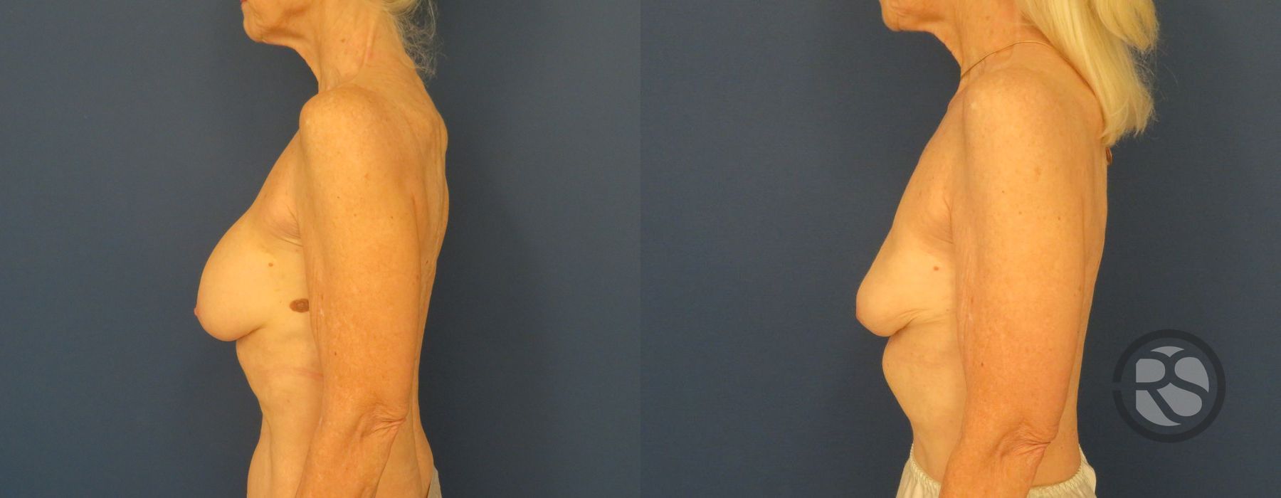 Before photo - Angle 5