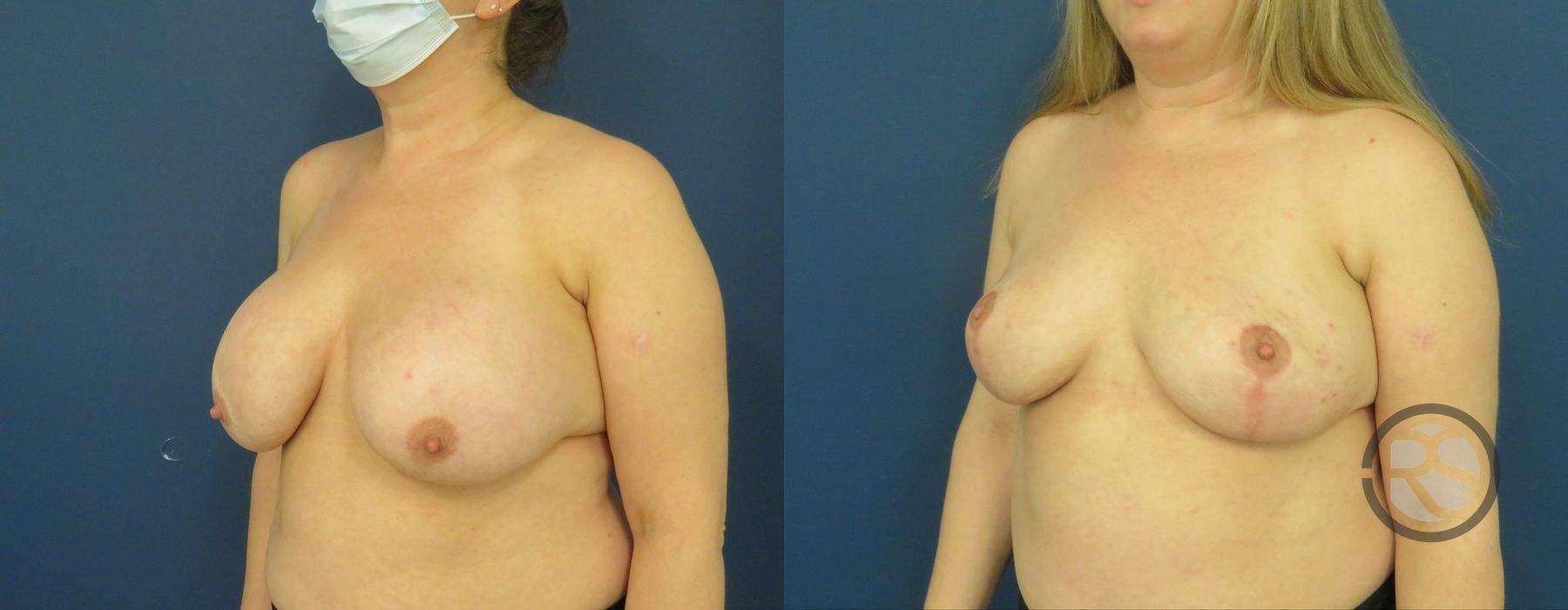 Before photo - Angle 4