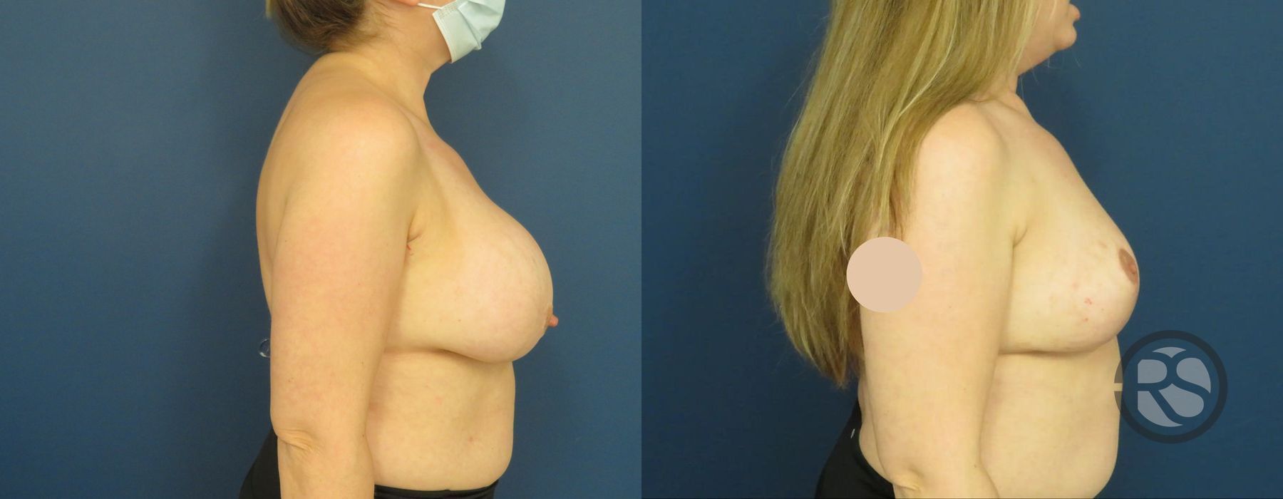 Before photo - Angle 3