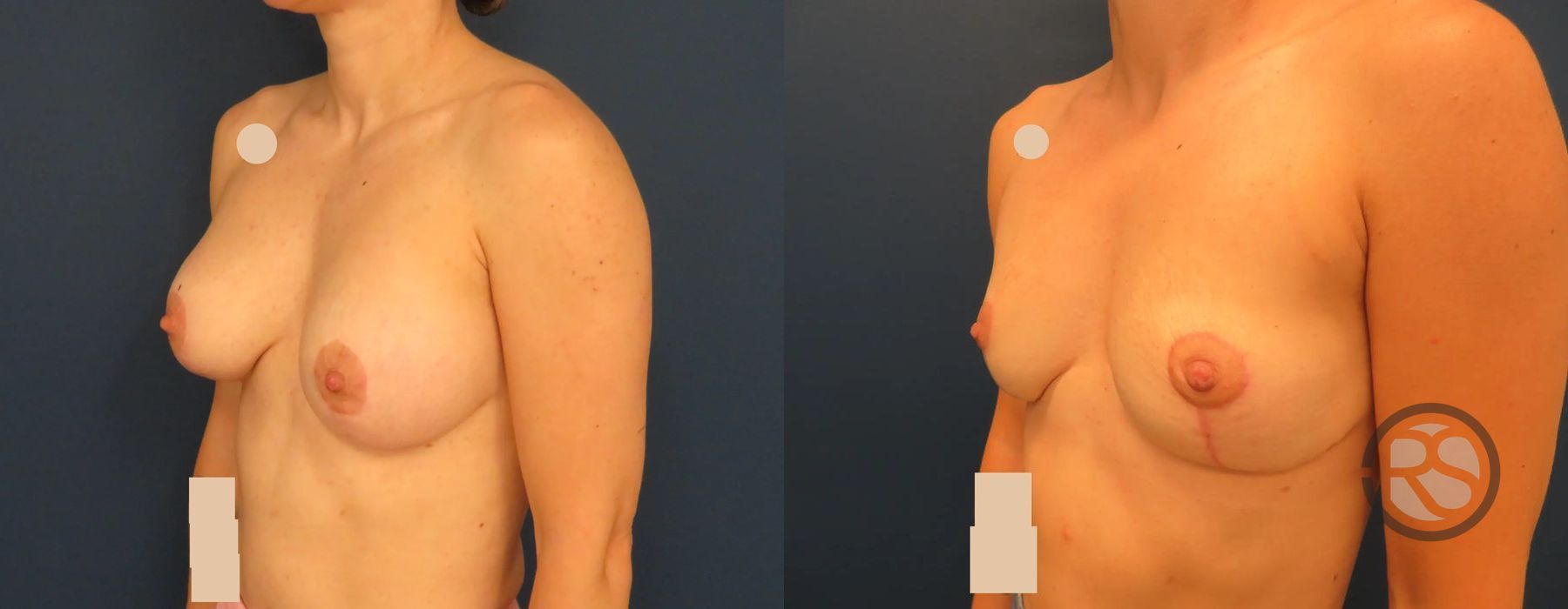 Before photo - Angle 4