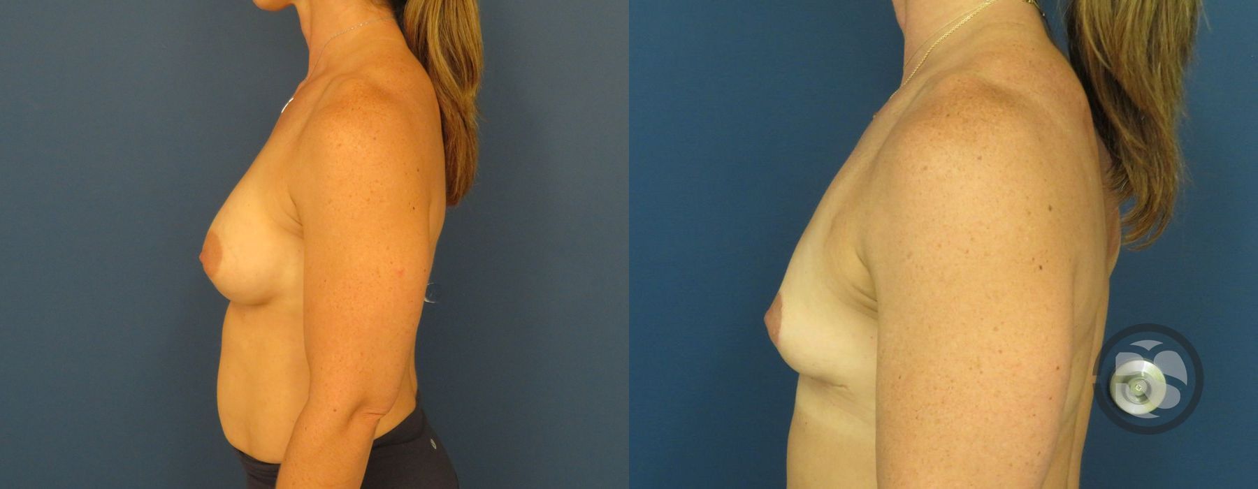 Before photo - Angle 5