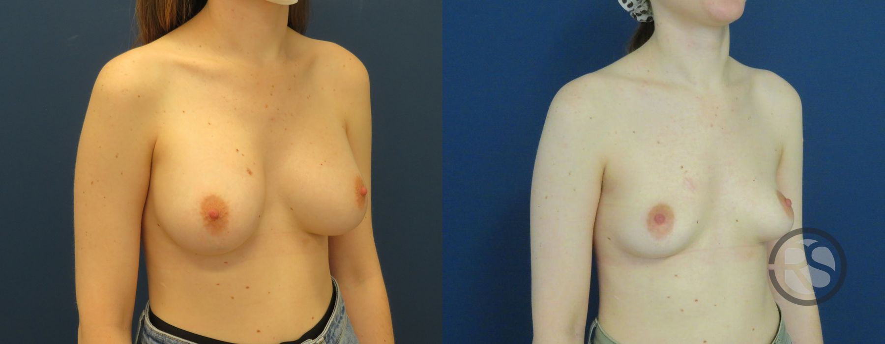 Before photo - Angle 2