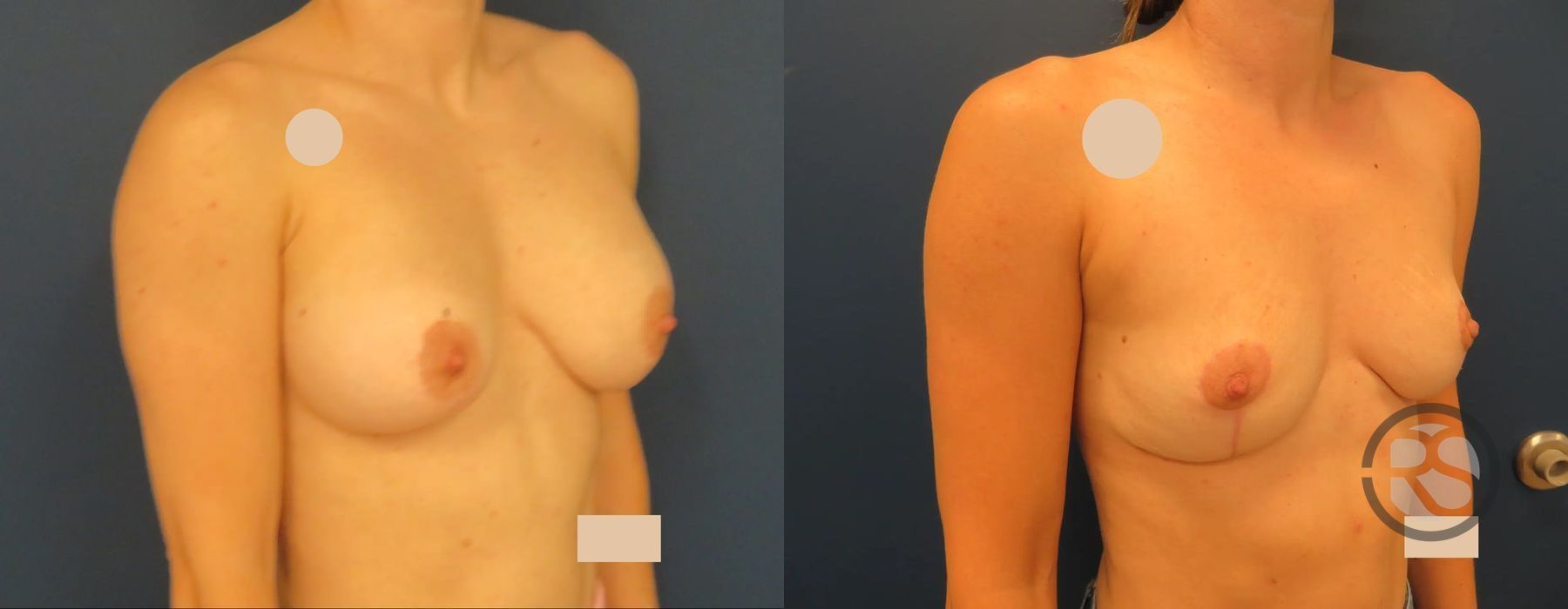 Before photo - Angle 2