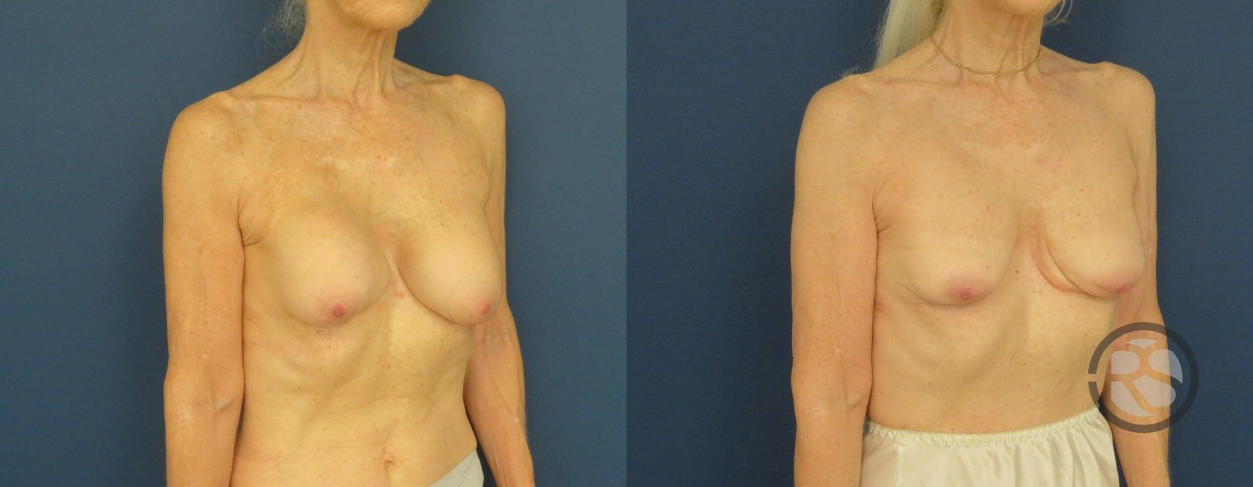 Before photo - Angle 2