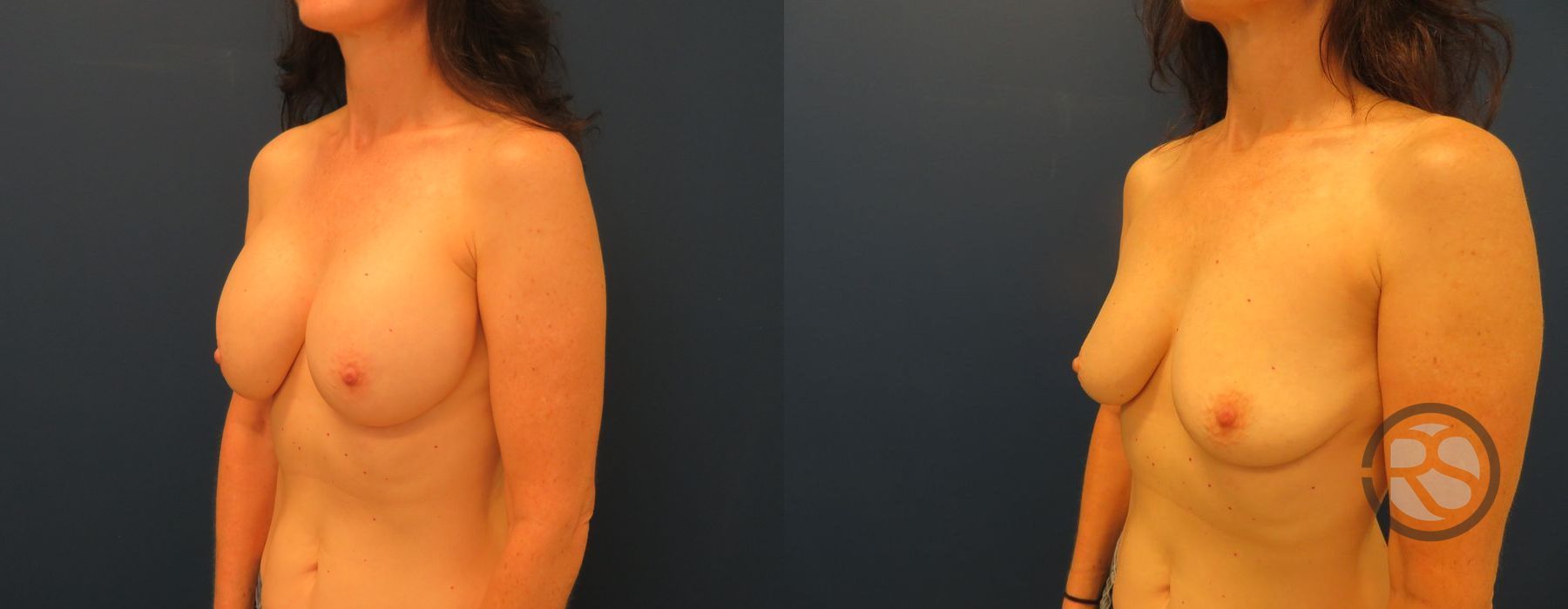 Before photo - Angle 4