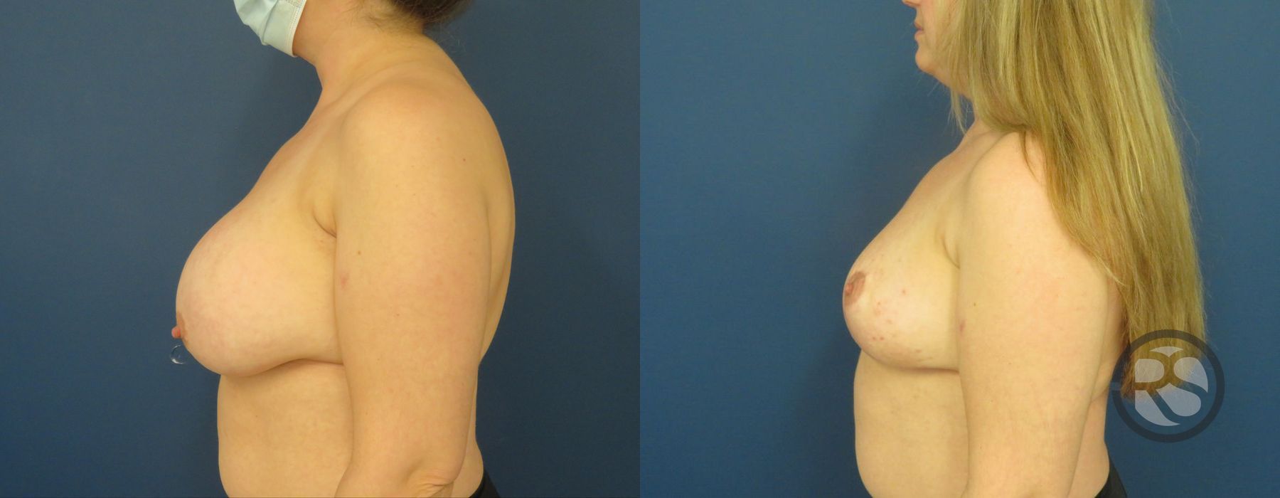 Before photo - Angle 5