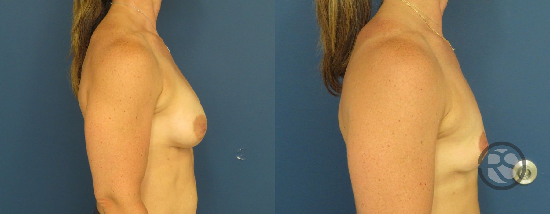 Before photo - Angle 3