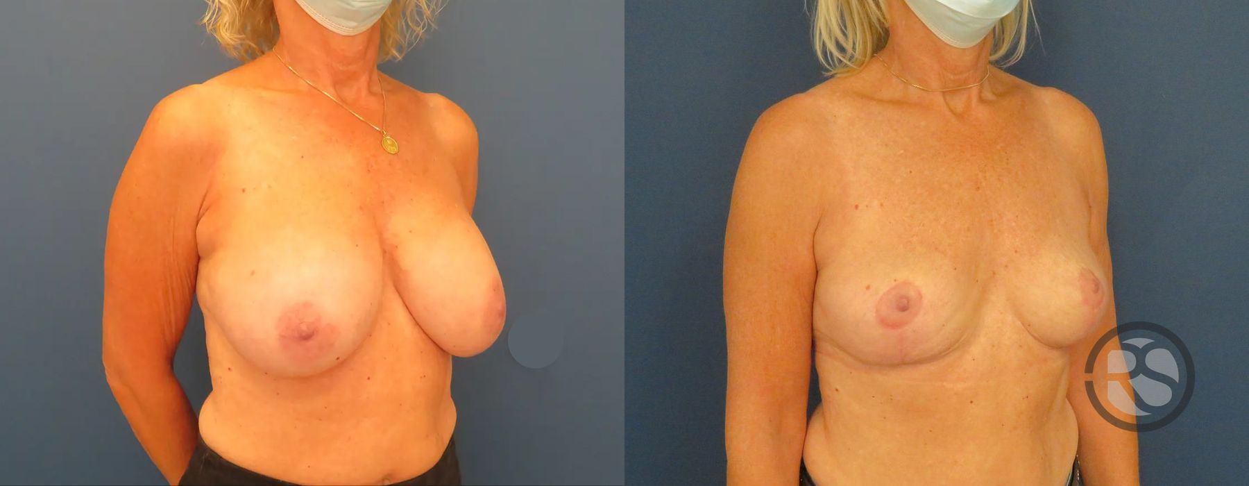 Before photo - Angle 2