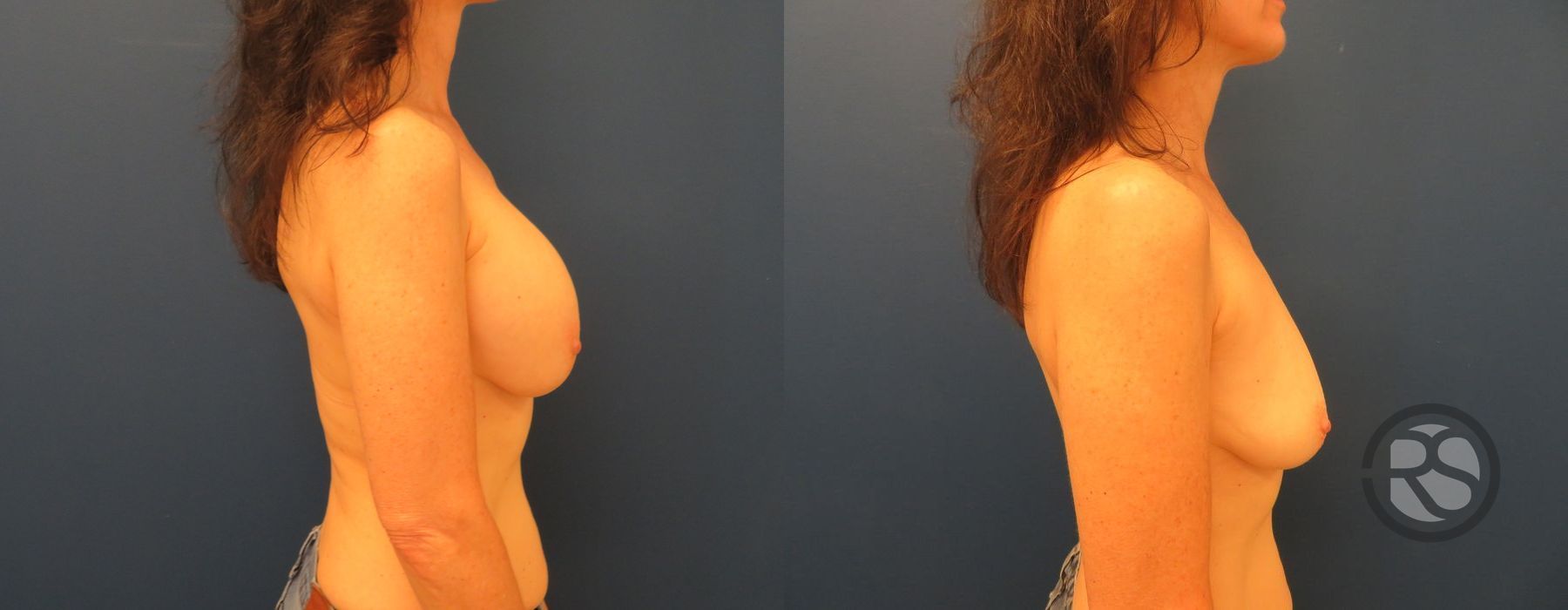 Before photo - Angle 3