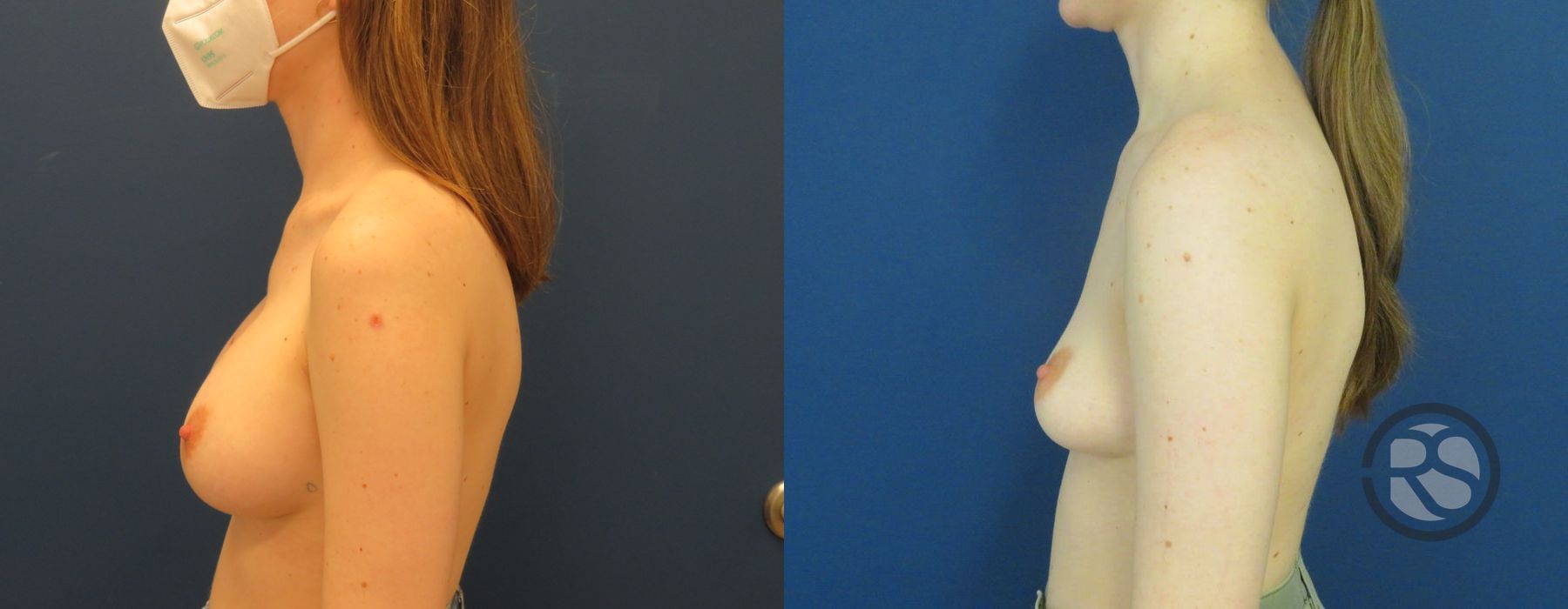 Before photo - Angle 5