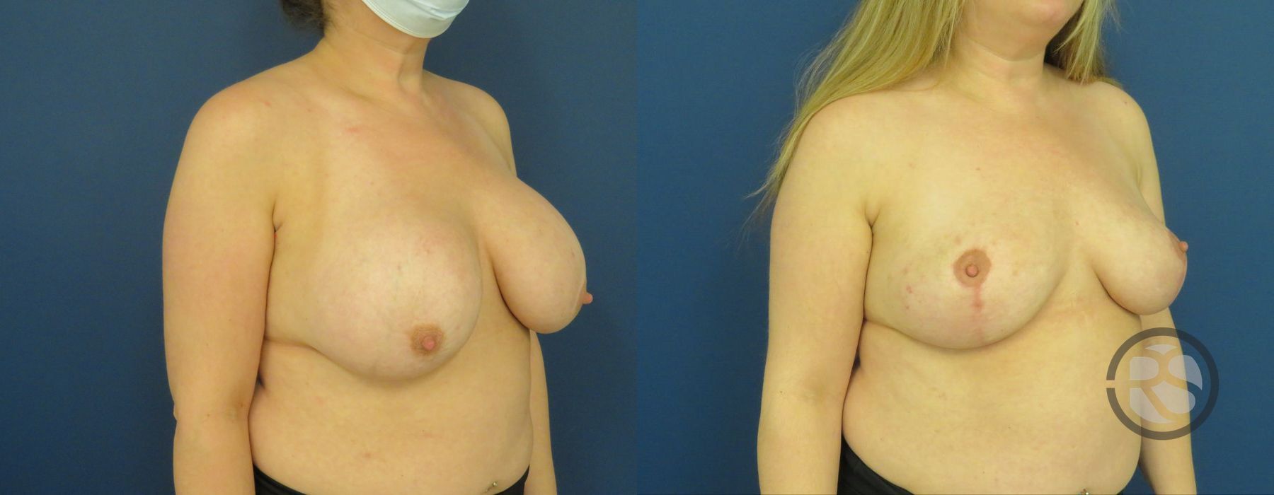 Before photo - Angle 2