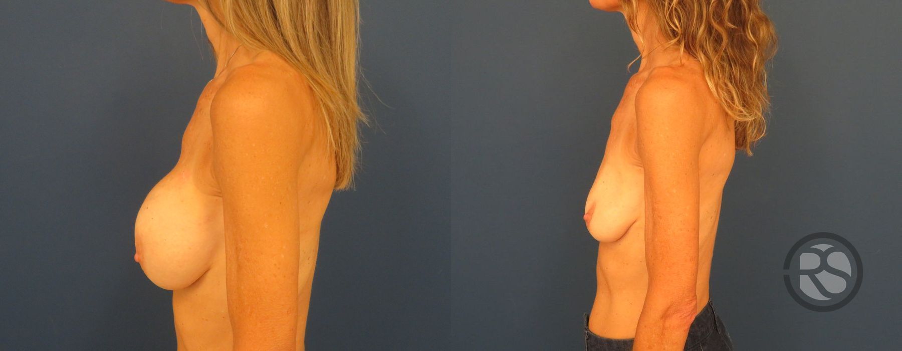 Before photo - Angle 5