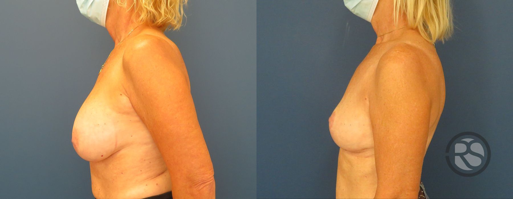 Before photo - Angle 5