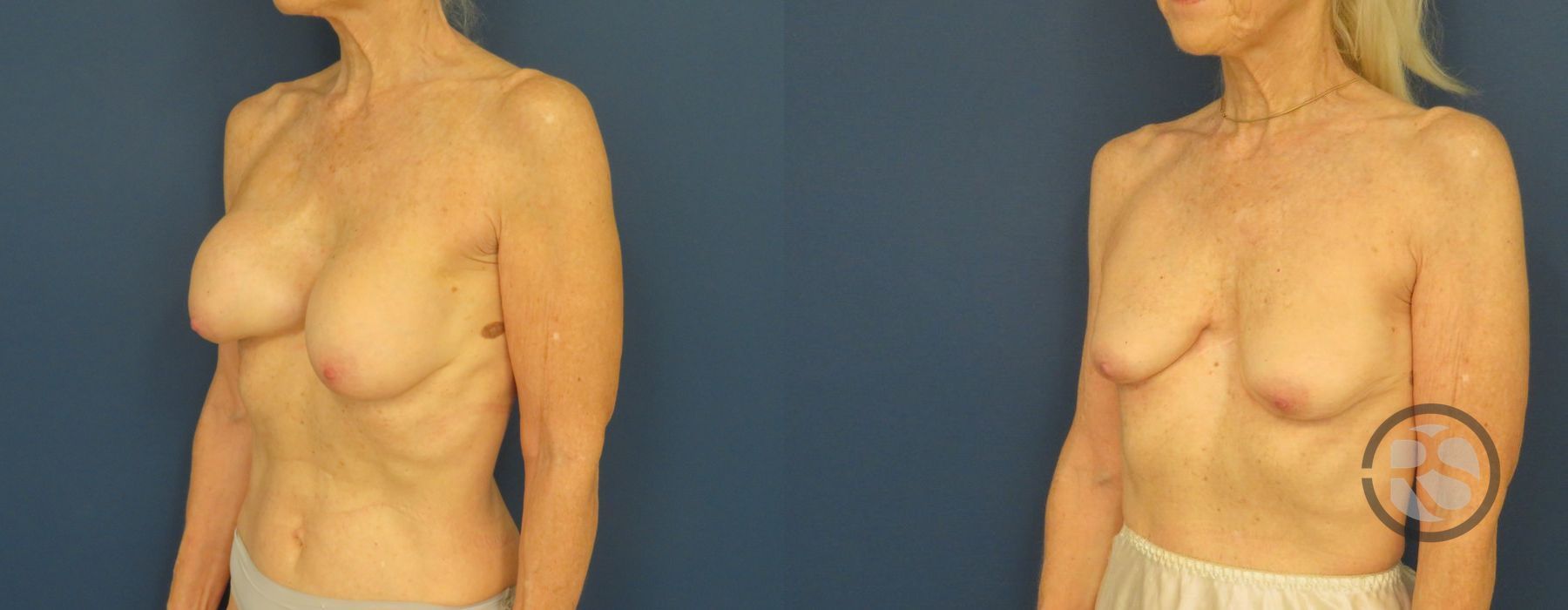 Before photo - Angle 4