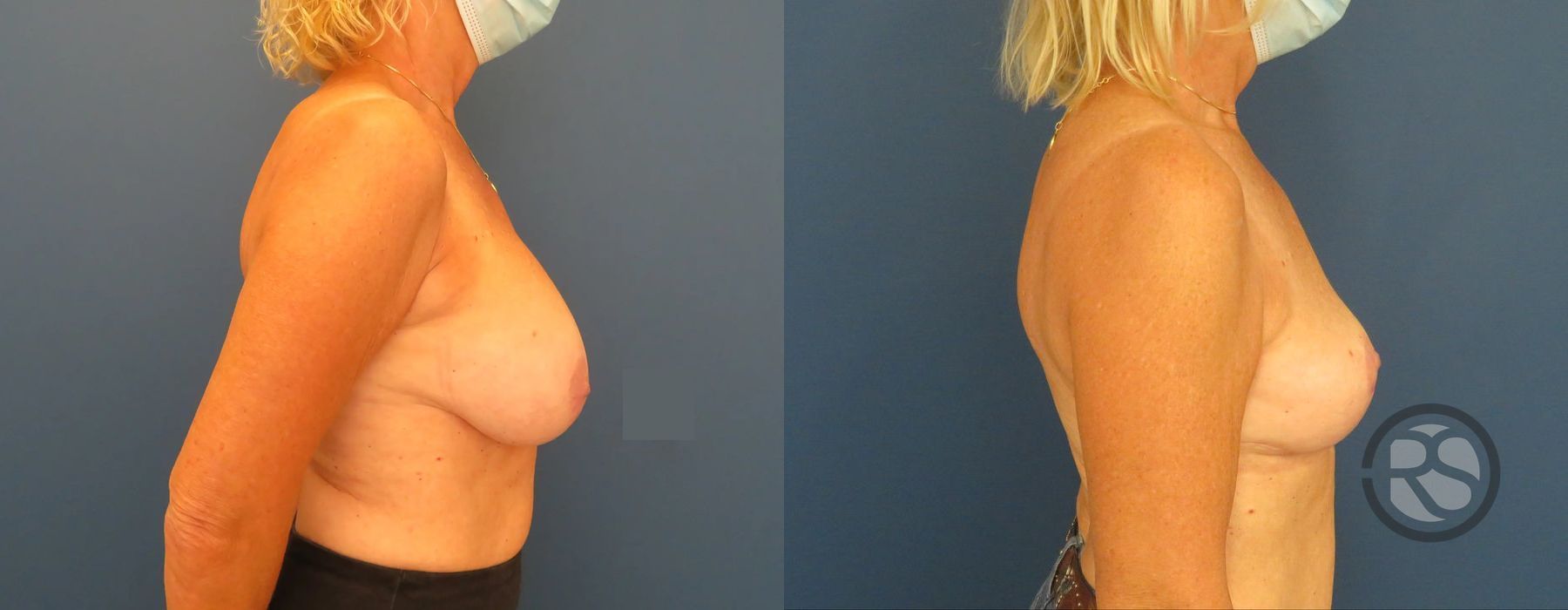 Before photo - Angle 3