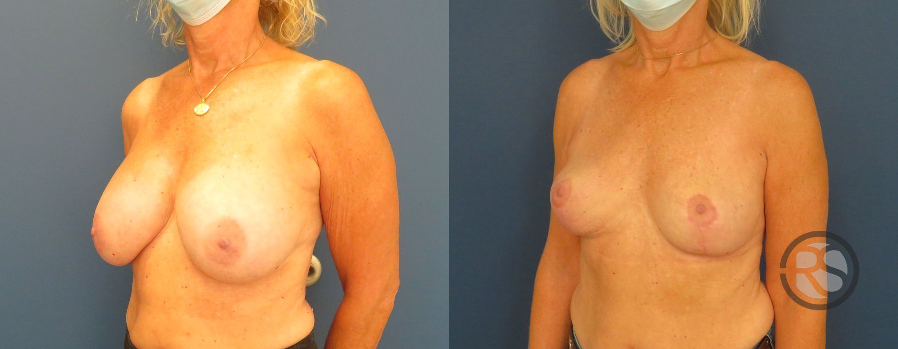 Before photo - Angle 4