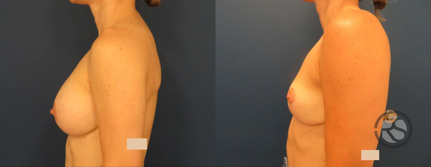 Before photo - Angle 5