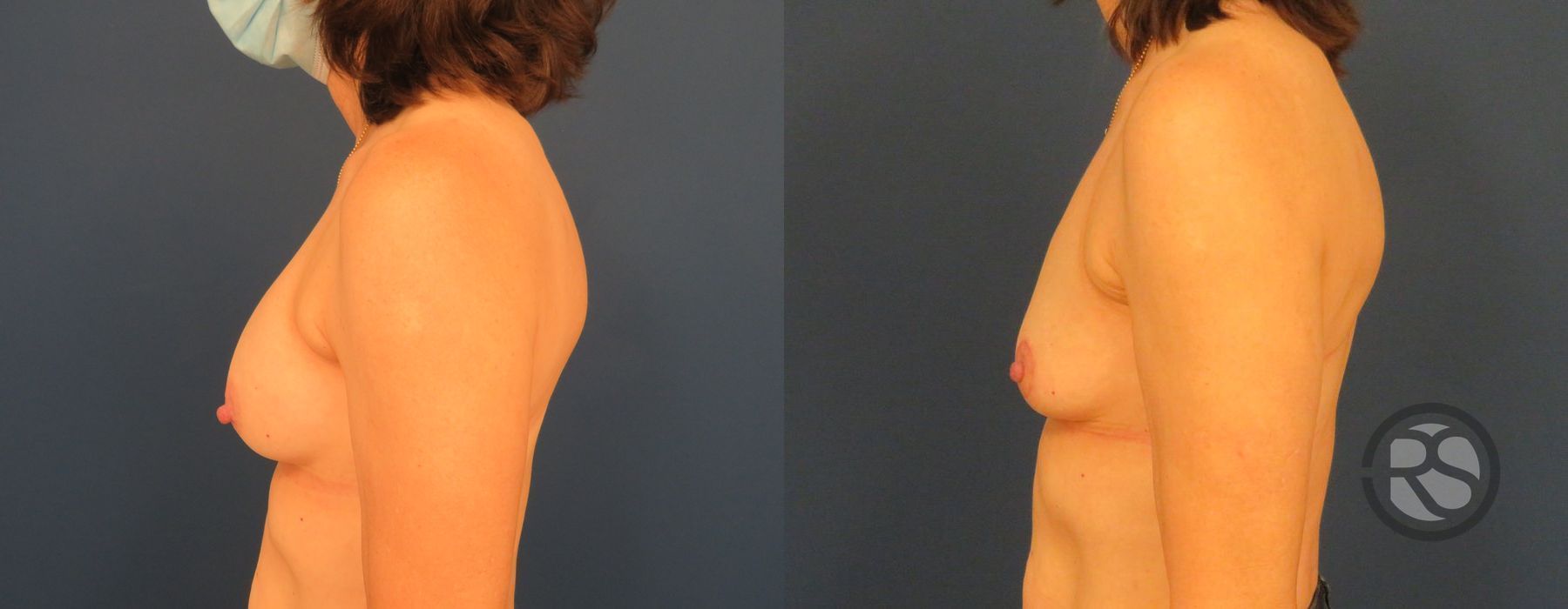 Before photo - Angle 3