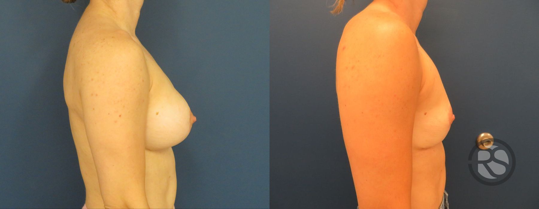 Before photo - Angle 3