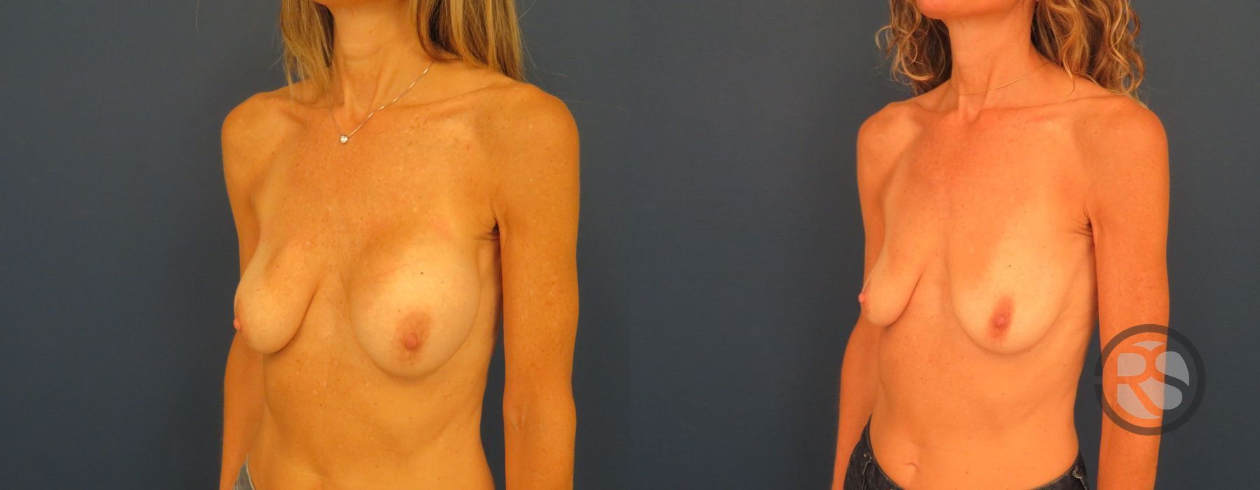 Before photo - Angle 4