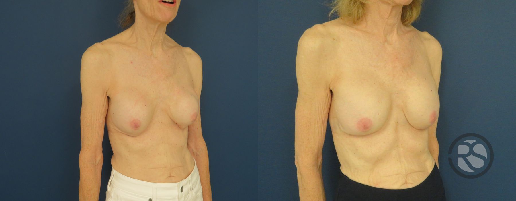 Before photo - Angle 2