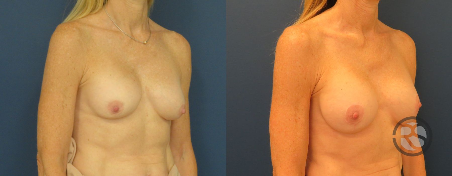 Before photo - Angle 2