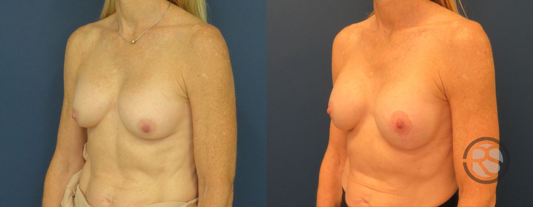 Before photo - Angle 4