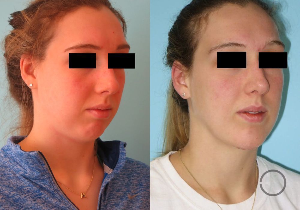 Before photo - Angle 3