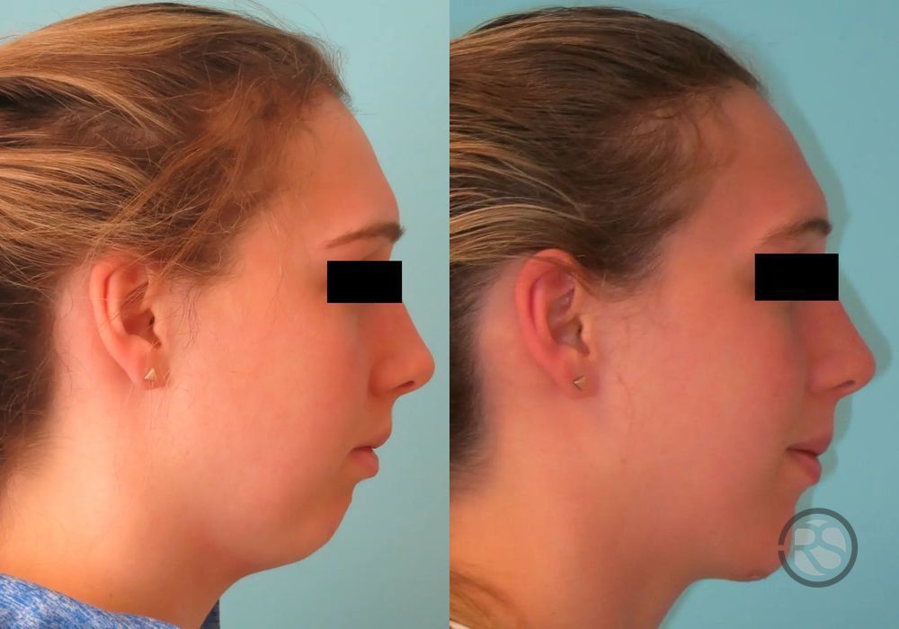 Before photo - Angle 2