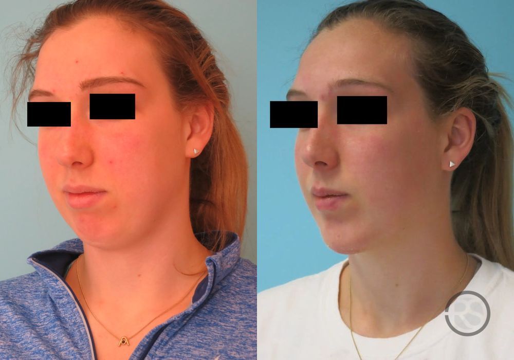 Before photo - Angle 4