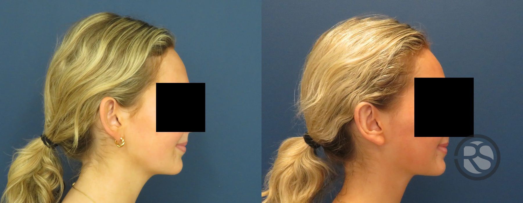 Before photo - Angle 2