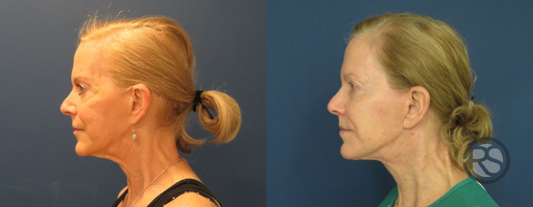 Before photo - Angle 3