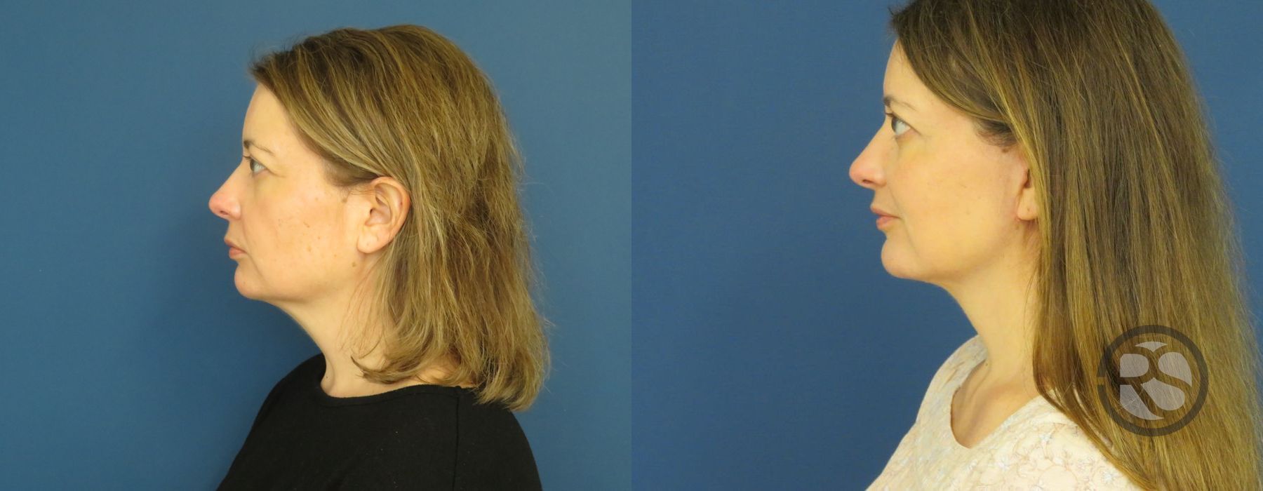 Before photo - Angle 5