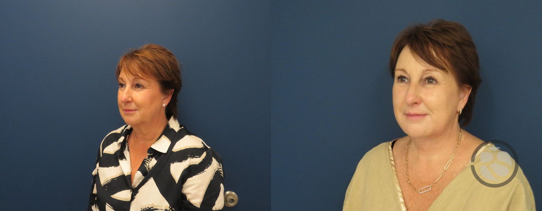 Before photo - Angle 5