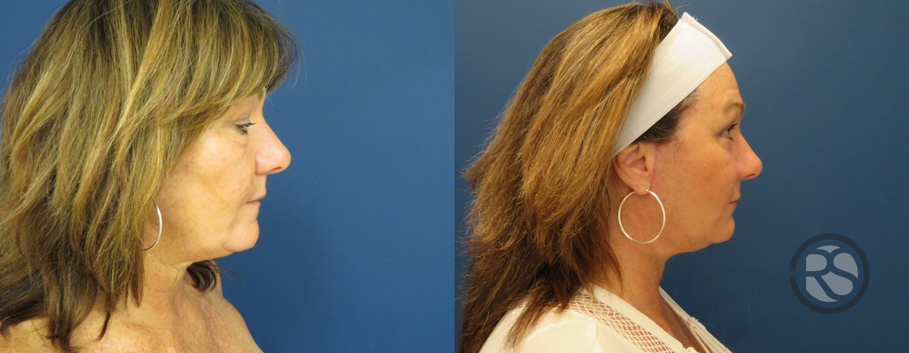 Before photo - Angle 3